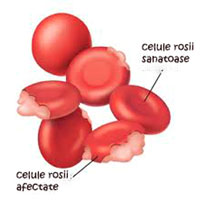 Anemia Hemolitica Autoimuna